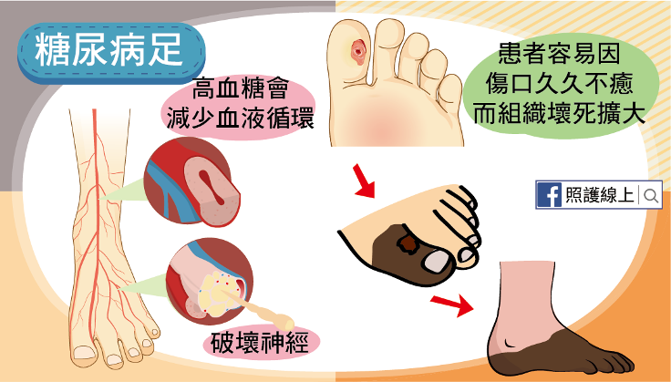 糖尿病足
